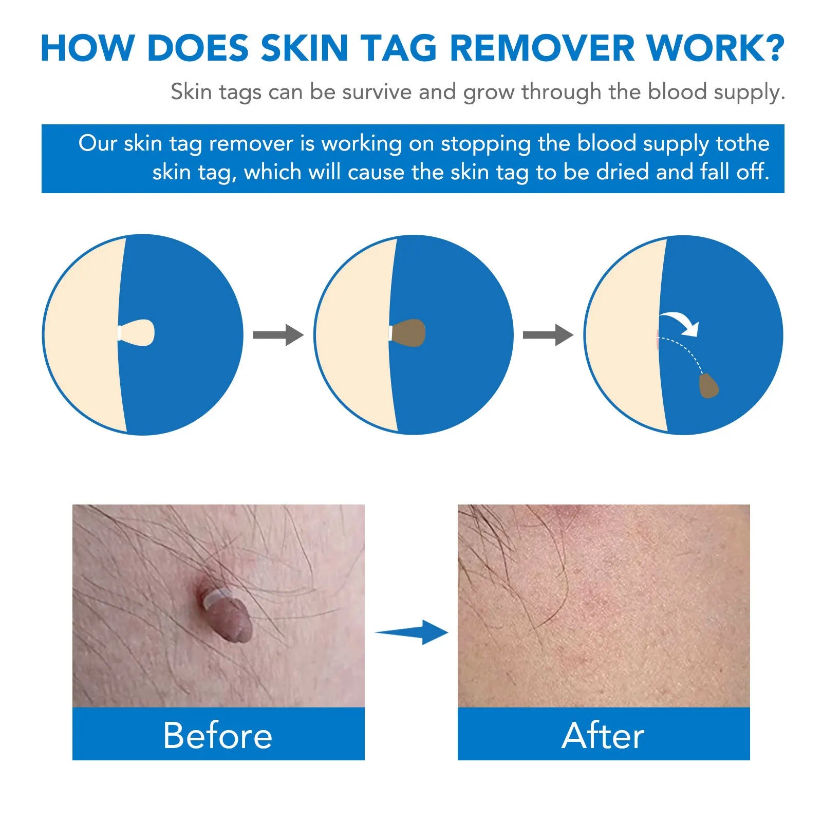Simple Wart Removal Tool Set Skin Tag Removeal Tool Easy To Clean Skin Care Tool Skin Tag Removal Care Products